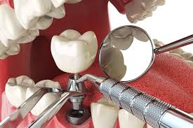 implant1