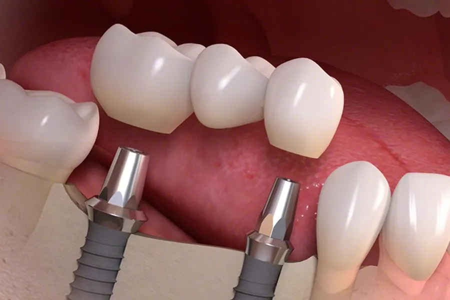 implant2