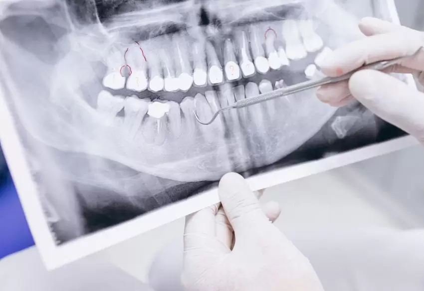 x-ray-teeth-1200x675