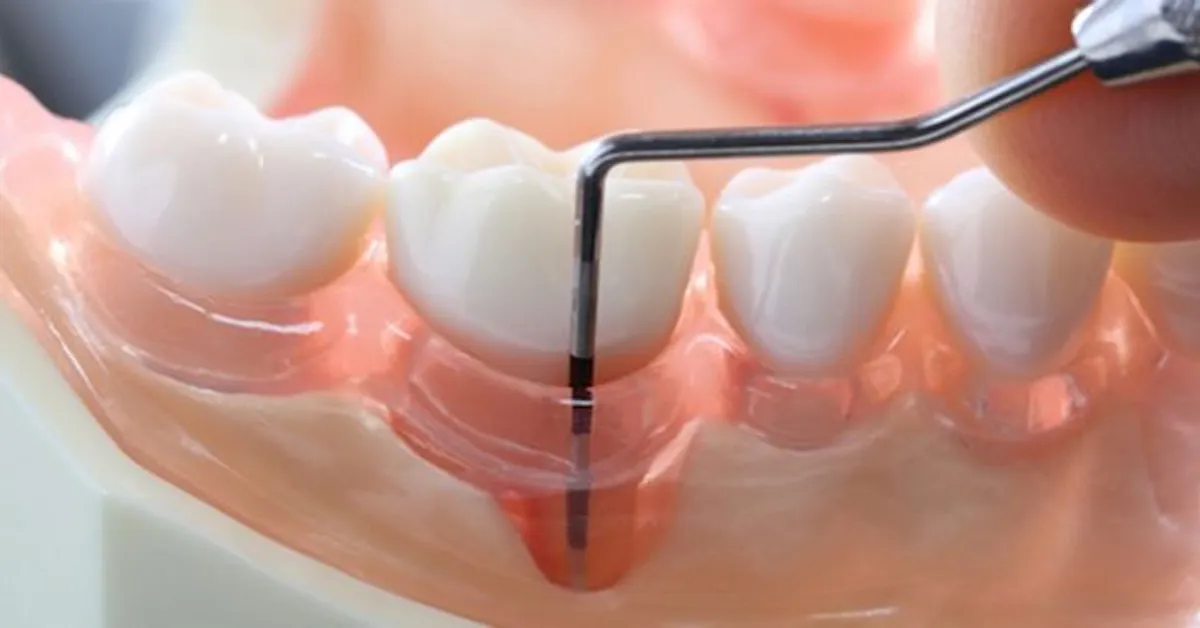 periodontoloji-nedir